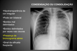 CONDENSAÇÃO OU CONSOLIDAÇÃO
•Hipotransparência de
cor irregular
•Pode ser bilateral
•Bordos mal
delimitados
•Bordos delimitados
por vezes nas cisuras
•Presença de
broncograma aéreo
•Sinal da silhueta
freqüente
 