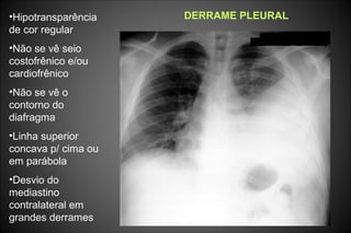 DERRAME PLEURAL•Hipotransparência
de cor regular
•Não se vê seio
costofrênico e/ou
cardiofrênico
•Não se vê o
contorno do
diafragma
•Linha superior
concava p/ cima ou
em parábola
•Desvio do
mediastino
contralateral em
grandes derrames
 