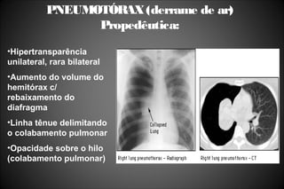 PNEUMOTÓRAX(derrame de ar)
Propedêutica:
•Hipertransparência
unilateral, rara bilateral
•Aumento do volume do
hemitórax c/
rebaixamento do
diafragma
•Linha tênue delimitando
o colabamento pulmonar
•Opacidade sobre o hilo
(colabamento pulmonar)
 