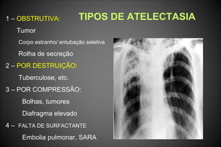 TIPOS DE ATELECTASIA1 – OBSTRUTIVA:
Tumor
Corpo estranho/ entubação seletiva
Rolha de secreção
2 – POR DESTRUIÇÃO:
Tuberculose, etc.
3 – POR COMPRESSÃO:
Bolhas, tumores
Diafragma elevado
4 – FALTA DE SURFACTANTE
Embolia pulmonar, SARA
 