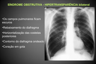 SÍNDROME OBSTRUTIVA - HIPERTRANSPARÊNCIA bilateral
•Os campos pulmonares ficam
escuros
•Rebaixamento do diafragma
•Horizontalização das costelas
posteriores
•Contorno do diafragma ondeado
•Coração em gota
 