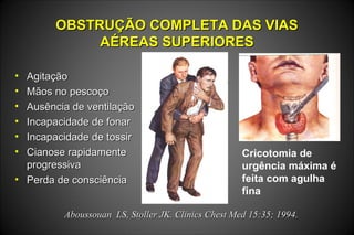 OBSTRUÇÃO COMPLETA DAS VIASOBSTRUÇÃO COMPLETA DAS VIAS
AÉREAS SUPERIORESAÉREAS SUPERIORES
• AgitaçãoAgitação
• Mãos no pescoçoMãos no pescoço
• Ausência de ventilaçãoAusência de ventilação
• Incapacidade de fonarIncapacidade de fonar
• Incapacidade de tossirIncapacidade de tossir
• Cianose rapidamenteCianose rapidamente
progressivaprogressiva
• Perda de consciênciaPerda de consciência
Aboussouan LS, Stoller JK. Clinics Chest Med 15:35; 1994.Aboussouan LS, Stoller JK. Clinics Chest Med 15:35; 1994.
Cricotomia de
urgência máxima é
feita com agulha
fina
 