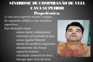 SÍNDROME DE COMPRESSÃO DE VEIA
CAVA SUPERIOR
Propedêutica:
A veia cava superior recebe o sangue
do segmento cefálico e dos membros
superiores.
Sua obstrução causa:
edema facial, subpalpebral
coloração acinzentada da face
estase jugular bilateral
edema de membros superiores
abaulamento das fossas
supraclaviculares
circulação colateral no tórax
síncope após crise de tosse
 