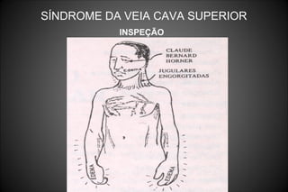 SÍNDROME DA VEIA CAVA SUPERIOR
INSPEÇÃO
 