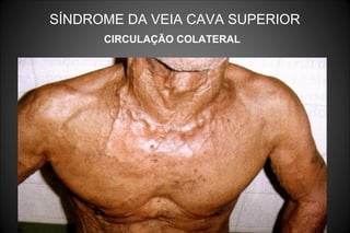 SÍNDROME DA VEIA CAVA SUPERIOR
CIRCULAÇÃO COLATERAL
 