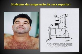 Síndrome da compressão da cava superior:
 