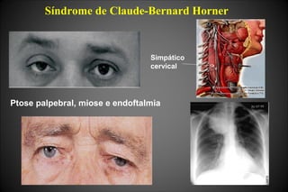 Síndrome de Claude-Bernard Horner
Ptose palpebral, miose e endoftalmia
Simpático
cervical
 