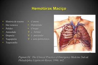 Hemotórax MaciçoHemotórax Maciço
• História de traumaHistória de trauma
• Dor torácicaDor torácica
• PalidezPalidez
• AnsiedadeAnsiedade
• DispnéiaDispnéia
• TaquipnéiaTaquipnéia
• TaquicardiaTaquicardia
• CianoseCianose
• HipotensãoHipotensão
• ChoqueChoque
∀ ↓↓ frêmitofrêmito
∀ ↓↓ percussãopercussão
∀ ↓↓ sons pulmonaressons pulmonares
Pigman EC. The Clinical Practice of Emergency Medcine 2nd ed.Pigman EC. The Clinical Practice of Emergency Medcine 2nd ed.
Philadelphia:Lippincott-Raven, 1996; 442.Philadelphia:Lippincott-Raven, 1996; 442.
 