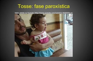 Tosse: fase paroxística
Vídeo obtido no Youtube: http://www.youtube.com/watch?v=4ldID97D-oU
 