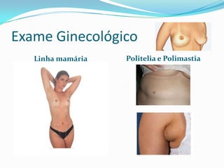 Exame Ginecológico
Linha mamária

Politelia e Polimastia

 