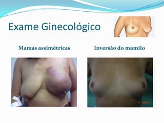 Exame Ginecológico
Mamas assimétricas

Inversão do mamilo

 
