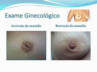 Exame Ginecológico
Inversão de mamilo

Retração do mamilo

 