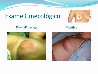 Exame Ginecológico
Peau d’orange

Mastite

 