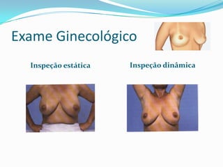 Exame Ginecológico
Inspeção estática

Inspeção dinâmica

 