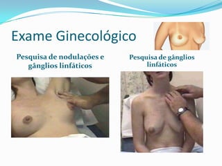 Exame Ginecológico
Pesquisa de nodulações e
gânglios linfáticos

Pesquisa de gânglios
linfáticos

 