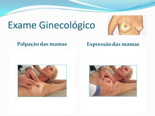 Exame Ginecológico
Palpação das mamas

Expressão das mamas

 