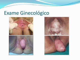 Exame Ginecológico

 