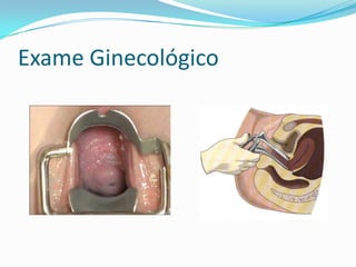 Exame Ginecológico

 