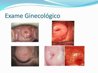 Exame Ginecológico

 