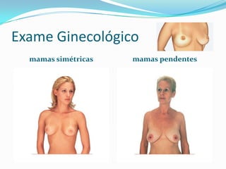 Exame Ginecológico
mamas simétricas

mamas pendentes

 