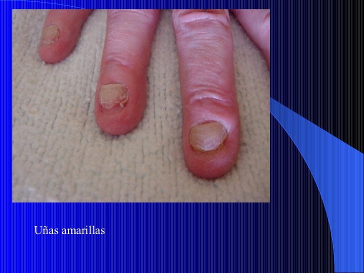 Que tal la psoriasis del cuero cabelludo de la foto