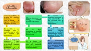Infección e
inflamación
como la mastitis y la
ectasia del conducto
mamario, son
características de
algunas condiciones
benignas del seno
La mastitis es una
infección que a
menudo ocurre entre
las mujeres que
amamantan
Cuando se bloquea un
conducto, esto
ocasiona que la leche
se acumule, causando
inflamación y
exposición a la
infección por bacteria
Si se forma un
absceso que contenga
pus, será necesario
drenarlo o extraerlo
quirúrgicamente
En su etapa
temprana, la mastitis
puede curarse con
antibióticos
El seno luce rojo y se
siente caliente,
sensible y grumoso
La ectasia del
conducto mamario es
una enfermedad de
las mujeres que se
acercan a la
menopausia
La ectasia del
conducto mamario
puede volverse
dolorosa y producir
una secreción espesa y
pegajosa de un color
entre gris y verde
El tratamiento
consiste en compresas
tibias, antibióticos y,
si es necesario, cirugía
para extraer el
conducto
 