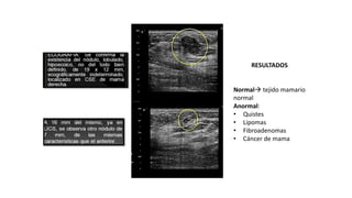 RESULTADOS
Normal tejido mamario
normal
Anormal:
• Quistes
• Lipomas
• Fibroadenomas
• Cáncer de mama
 