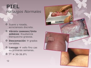 PIEL
Hallazgos Normales
 Suave y rosada,
acrocianosis discreta.
 Vérmix caseoso/Unto
sebáceo sustancia
blanquecina grasosa.
 Descamación  grados
variables.
 Lanugo  vello fino cae
en primeras semanas.
 T°  36-36.8°c
12
 
