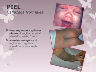 PIEL
Hallazgos Normales
 Hemangiomas capilares
planos  región occipital,
párpados, nariz, frente.
 Mancha mongólica 
región sacro-glútea o
superficie extensora de
MMII .
13
 