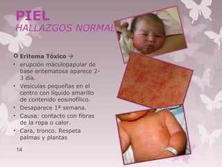  Eritema Tóxico 
• erupción máculopapular de
base eritematosa aparece 2-
3 día.
• Vesículas pequeñas en el
centro con líquido amarillo
de contenido eosinofílico.
• Desaparece 1ª semana.
• Causa: contacto con fibras
de la ropa o calor.
• Cara, tronco. Respeta
palmas y plantas
14
PIEL
HALLAZGOS NORMALES
 