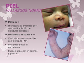  Millium 
• Micropápulas amarillas por
sobreestimulación de
glándulas sebáceas.
 Melanosis pustulosa 
• Vesiculopústulas amarillas
con infiltrado PMN.
• Presentes desde el
nacimiento.
• Pueden aparecer en palmas
y plantas.
15
PIEL
HALLAZGOS NORMALES
 