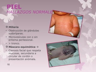 Miliaria
• Obstrucción de glándulas
sudoríparas.
• Microvesículas con o sin
eritema perilesional.
• > tronco.
 Máscara equimótica 
• Cianosis facial que respeta
mucosas, secundaria a
circular de cordón o
presentación anómala.
16
PIEL
HALLAZGOS NORMALES
 