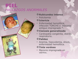  Rubicundez intensa
• Policitemia
 Ictericia
• Enfermedad hemolítica,
infección TORCHS o meconio
antiguo impregnado *.
 Cianosis generalizada
• Cardiopatía congénita, distrés
respiratorio.
 Palidez
• Anemia, hipovolemia, shock,
enfermedad hemolítica.
 Tinte verdoso
• Meconio impregnado en
vérmix.17
PIEL
HALLAZGOS ANORMALES
 