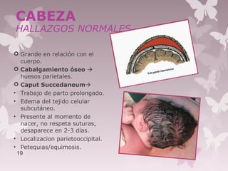  Grande en relación con el
cuerpo.
 Cabalgamiento óseo 
huesos parietales.
 Caput Succedaneum
• Trabajo de parto prolongado.
• Edema del tejido celular
subcutáneo.
• Presente al momento de
nacer, no respeta suturas,
desaparece en 2-3 días.
• Localizacion parietooccipital.
• Petequias/equimosis.
19
CABEZA
HALLAZGOS NORMALES
 