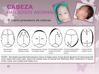  Cierre prematuro de suturas
22
CABEZA
HALLAZGOS ANORMALES
 