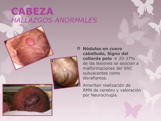  Nódulos en cuero
cabelludo, Signo del
collarde pelo  20-37%
de las lesiones se asocian a
malformaciones del SNC
subyacentes como
disrafismos.
 Ameritan realización de
RMN de cerebro y valoración
por Neurocirugía.
23
CABEZA
HALLAZGOS ANORMALES
 