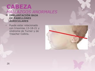  IMPLANTACIÓN BAJA
DE PABELLONES
AURICULARES
• Puede estar relacionado
con trisomías 13-18-21 y
síndrome de Turner y de
Treacher Collins.
26
CABEZA
HALLAZGOS ANORMALES
 