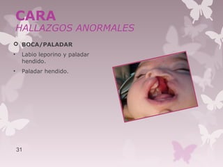  BOCA/PALADAR
• Labio leporino y paladar
hendido.
• Paladar hendido.
31
CARA
HALLAZGOS ANORMALES
 