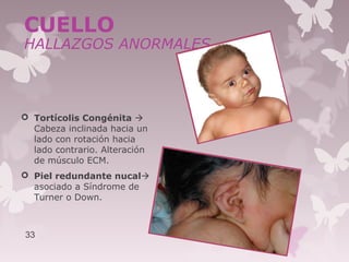  Tortícolis Congénita 
Cabeza inclinada hacia un
lado con rotación hacia
lado contrario. Alteración
de músculo ECM.
 Piel redundante nucal
asociado a Síndrome de
Turner o Down.
33
CUELLO
HALLAZGOS ANORMALES
 