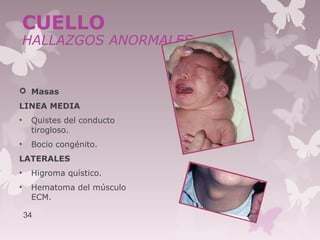  Masas
LINEA MEDIA
• Quistes del conducto
tirogloso.
• Bocio congénito.
LATERALES
• Higroma quístico.
• Hematoma del músculo
ECM.
34
CUELLO
HALLAZGOS ANORMALES
 