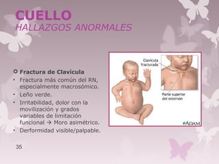  Fractura de Clavícula
• Fractura más común del RN,
especialmente macrosómico.
• Leño verde.
• Irritabilidad, dolor con la
movilización y grados
variables de limitación
funcional  Moro asimétrico.
• Derformidad visible/palpable.
35
CUELLO
HALLAZGOS ANORMALES
 