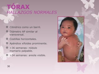  Cilíndrico como un barril.
 Diámetro AP similar al
transversal.
 Costillas horizontales.
 Apéndice xifoides prominente.
 >36 semanas: nódulo
mamario palpable.
 >34 semanas: areola visible.
36
TÓRAX
HALLAZGOS NORMALES
 
