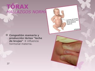  Congestión mamaria y
producción láctea “leche
de brujas”  influencia
hormonal materna.
37
TÓRAX
HALLAZGOS NORMALES
 