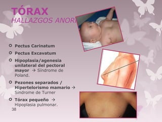  Pectus Carinatum
 Pectus Excavatum
 Hipoplasia/agenesia
unilateral del pectoral
mayor  Síndrome de
Poland.
 Pezones separados /
Hipertelorismo mamario 
Síndrome de Turner
 Tórax pequeño 
Hipoplasia pulmonar.
38
TÓRAX
HALLAZGOS ANORMALES
 
