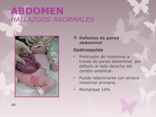  Defectos de pared
abdominal
Gastrosquisis
• Protrusión de intestinos a
través de pared abdominal, por
defecto al lado derecho del
cordón umbilical.
• Puede relacionarse con atresia
intestinal primaria.
• Mortalidad 10%
44
ABDOMEN
HALLAZGOS ANORMALES
 