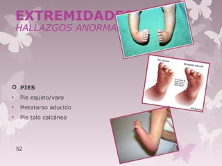  PIES
• Pie equino/varo
• Metatarso aducido
• Pie talo calcáneo
52
EXTREMIDADES
HALLAZGOS ANORMALES
 