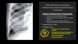 Enfermedades pulmonares
intersticiales predominantemente
reticulares
EDEMA INTERSTICIAL PULMONAR.
1. Aumento de la presión capilar (ICC)
2. Aumento de la permeabilidad capilar (reacción
alérgica)
3. Disminución de la absorción de líquidos
(bloqueo linfático por enfermedad metastásica)
• Resolución en < 48 h
• Hallazgos clave:
• Líquido en las cisuras (mayor y
menor)
• Manguito peribronquial (líquido en
las paredes de los bronquiolos)
• Derrames pleurales
• Líneas B de Kerley
 