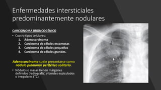 Enfermedades intersticiales
predominantemente nodulares
CARCIONOMA BRONCOGÉNICO
• Cuatro tipos celulares:
1. Adenocarcinoma
2. Carcinoma de células escamosas
3. Carcinoma de células pequeñas
4. Carcinoma de células grandes.
Adenocarcinoma suele presentarse como
nódulo pulmonar periférico solitario.
• Nódulos o masas tienen márgenes
definidos (radiografía) y bordes espiculados
o irregulares (TC)
 