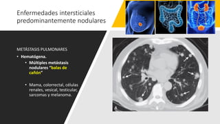 Enfermedades intersticiales
predominantemente nodulares
METÁSTASIS PULMONARES
• Hematógena.
• Múltiples metástasis
nodulares “balas de
cañón”
• Mama, colorrectal, células
renales, vesical, testicular,
sarcomas y melanoma.
 