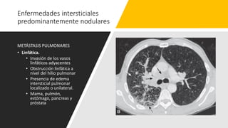 Enfermedades intersticiales
predominantemente nodulares
METÁSTASIS PULMONARES
• Linfática.
• Invasión de los vasos
linfáticos adyacentes
• Obstrucción linfática a
nivel del hilio pulmonar
• Presencia de edema
intersticial pulmonar
localizado o unilateral.
• Mama, pulmón,
estómago, pancreas y
próstata
 